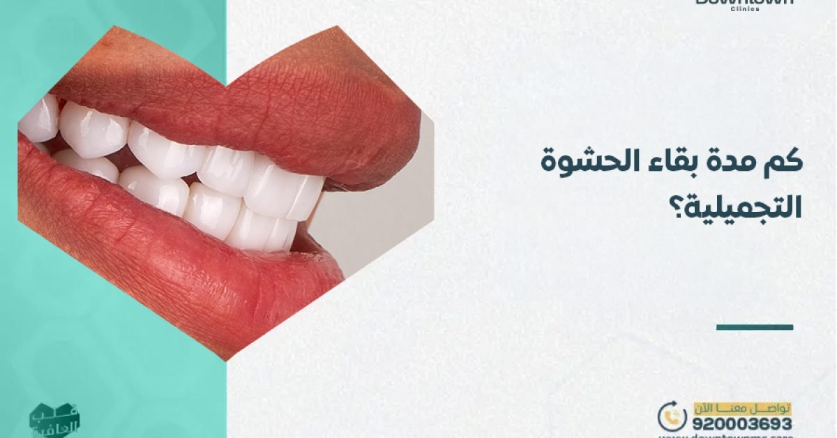 كم مدة بقاء الحشوة التجميلية