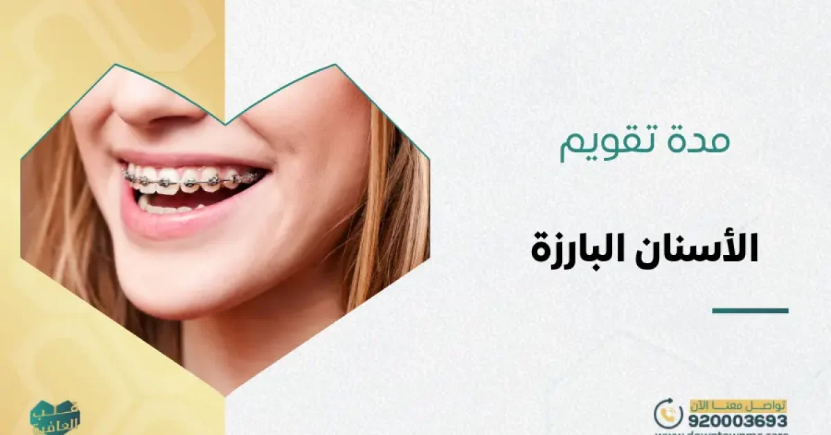كم مدة تقويم الأسنان البارزة