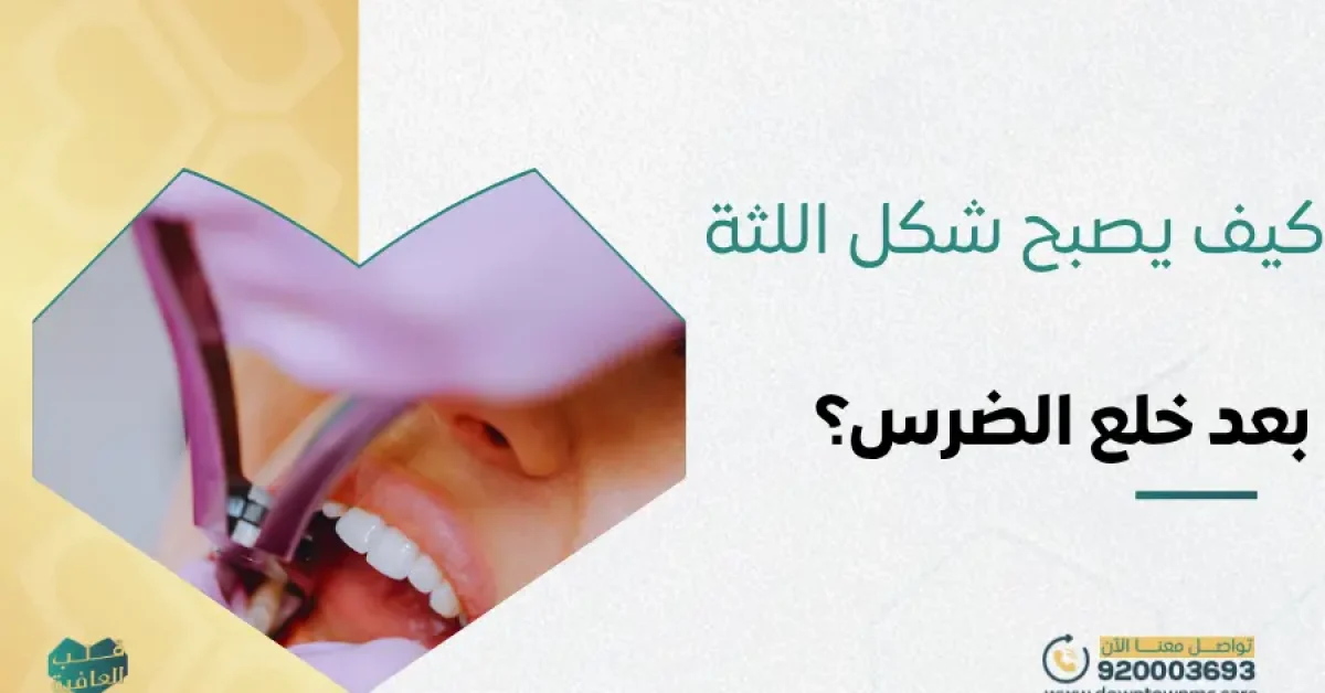 كيف يصبح شكل اللثة بعد خلع الضرس؟