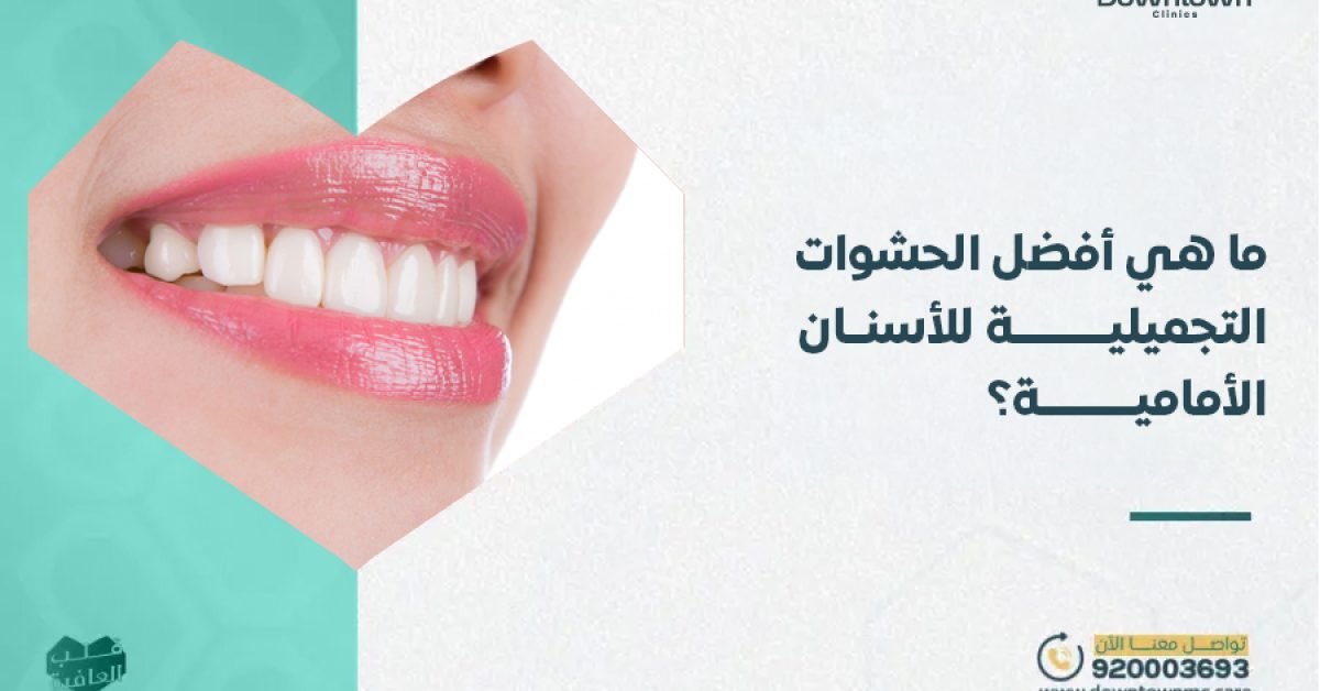 أفضل الحشوات التجميلية للأسنان الأمامية