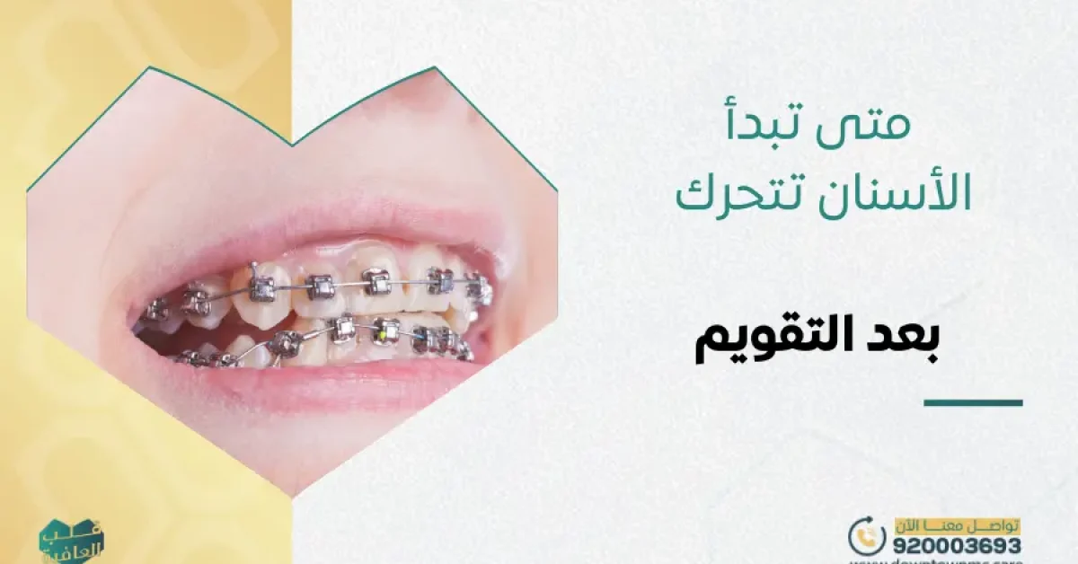 متى تبدأ الأسنان تتحرك بعد التقويم؟