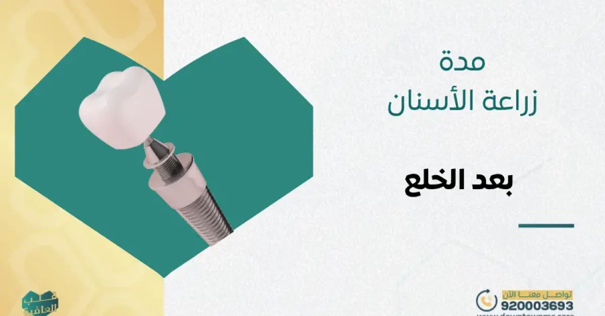 مدة زراعة الأسنان بعد الخلع