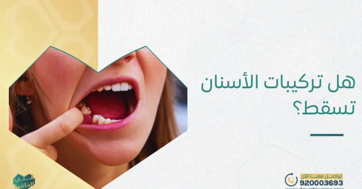 هل تركيبات الأسنان تسقط؟
