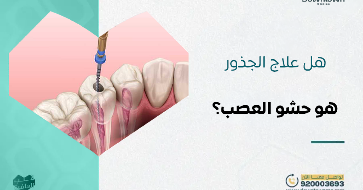 هل علاج الجذور هو حشو العصب