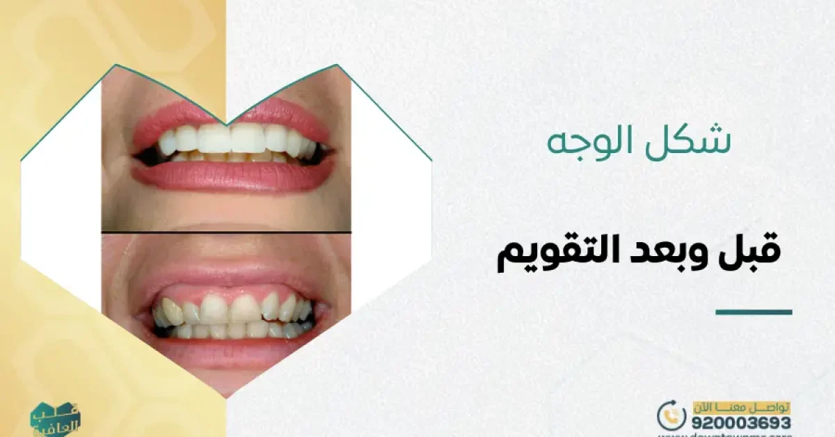 هل يتغير شكل الوجه قبل وبعد التقويم